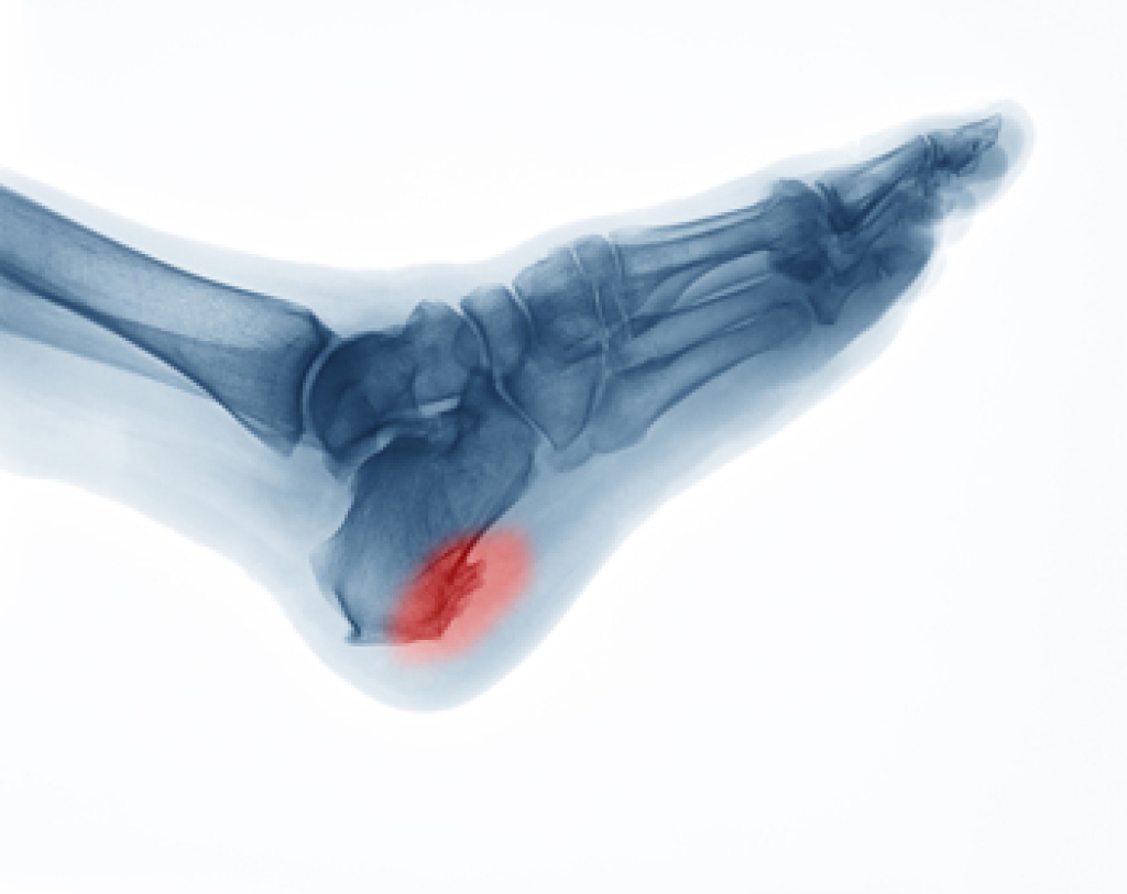 Heel Spurs and the Benefits of Early Podiatry Care
