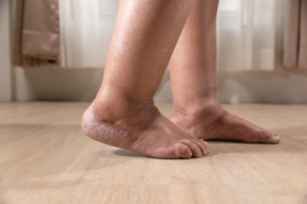 Understanding the Causes and Symptoms of Swollen Feet