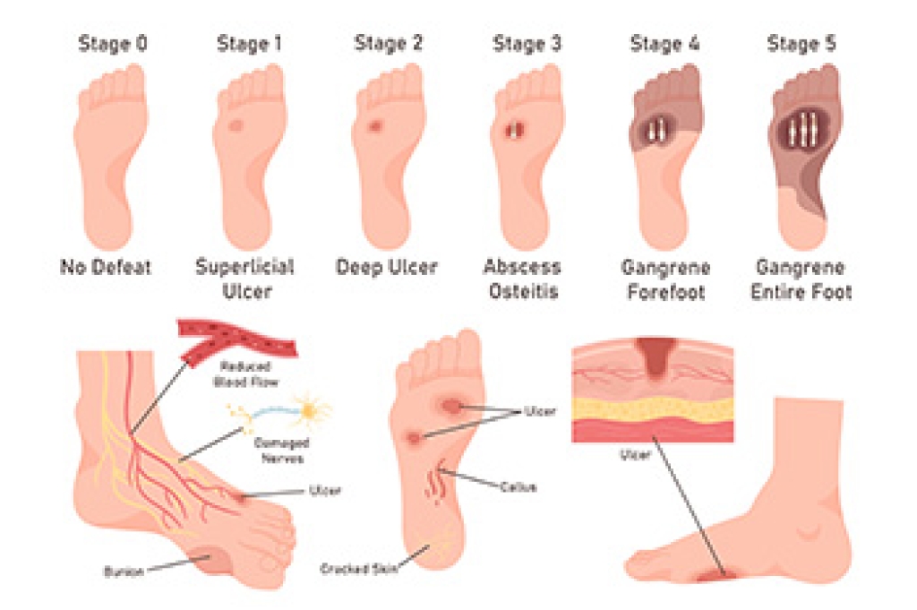 Diabetes-Related Foot Ulcers Affecting Feet and Toes