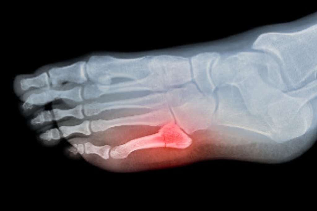 Toe Fractures Explained
