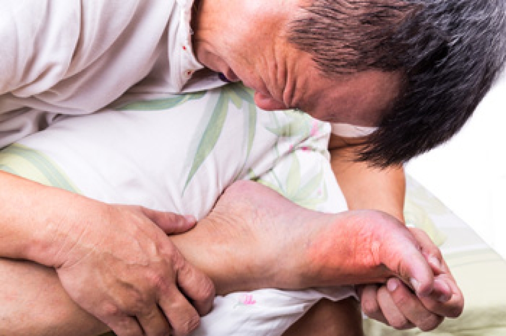 Gout and Foot Pain