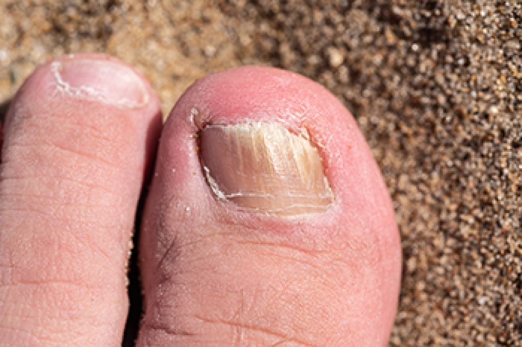 When Toenails Become Thick and Discolored