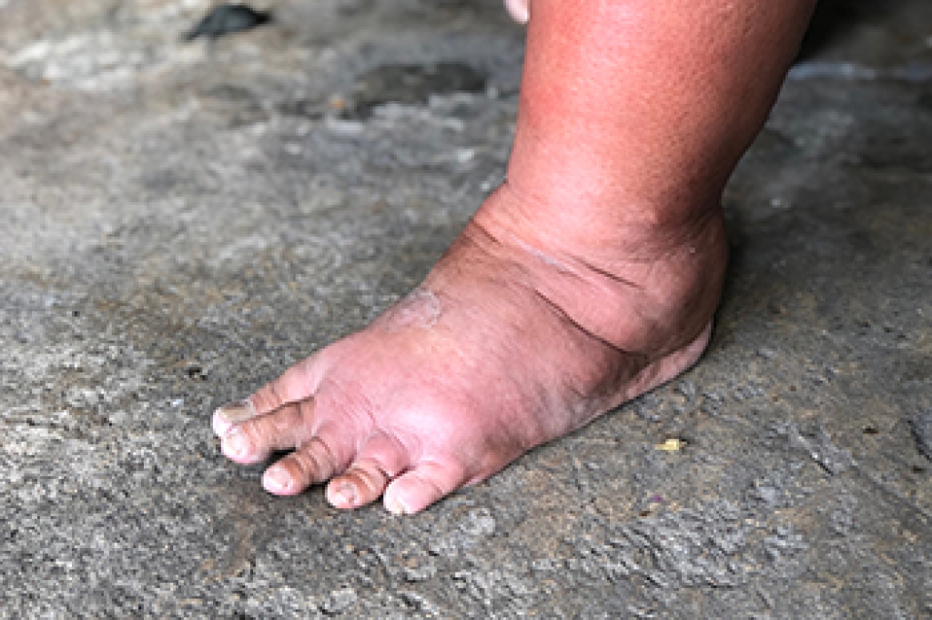 Understanding Ankle Pain and Cankles