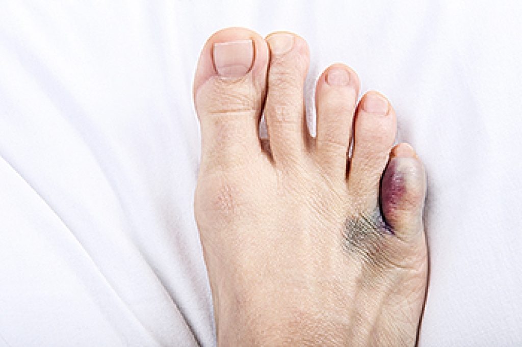 Reasons Your Pinky Toe Hurts