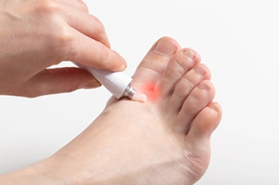 How a Podiatrist Can Help Conquer Athlete’s Foot